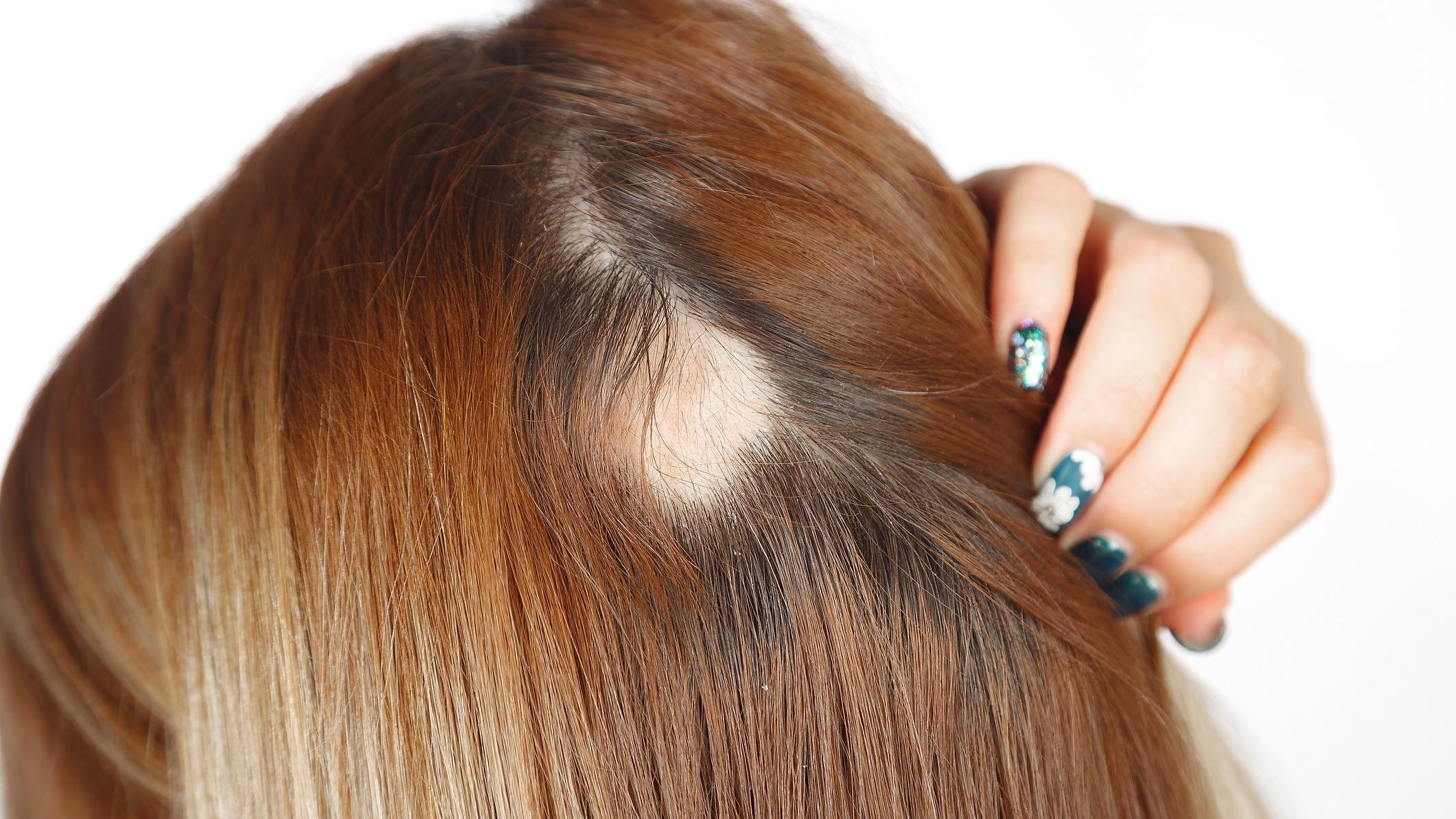 Alopecia