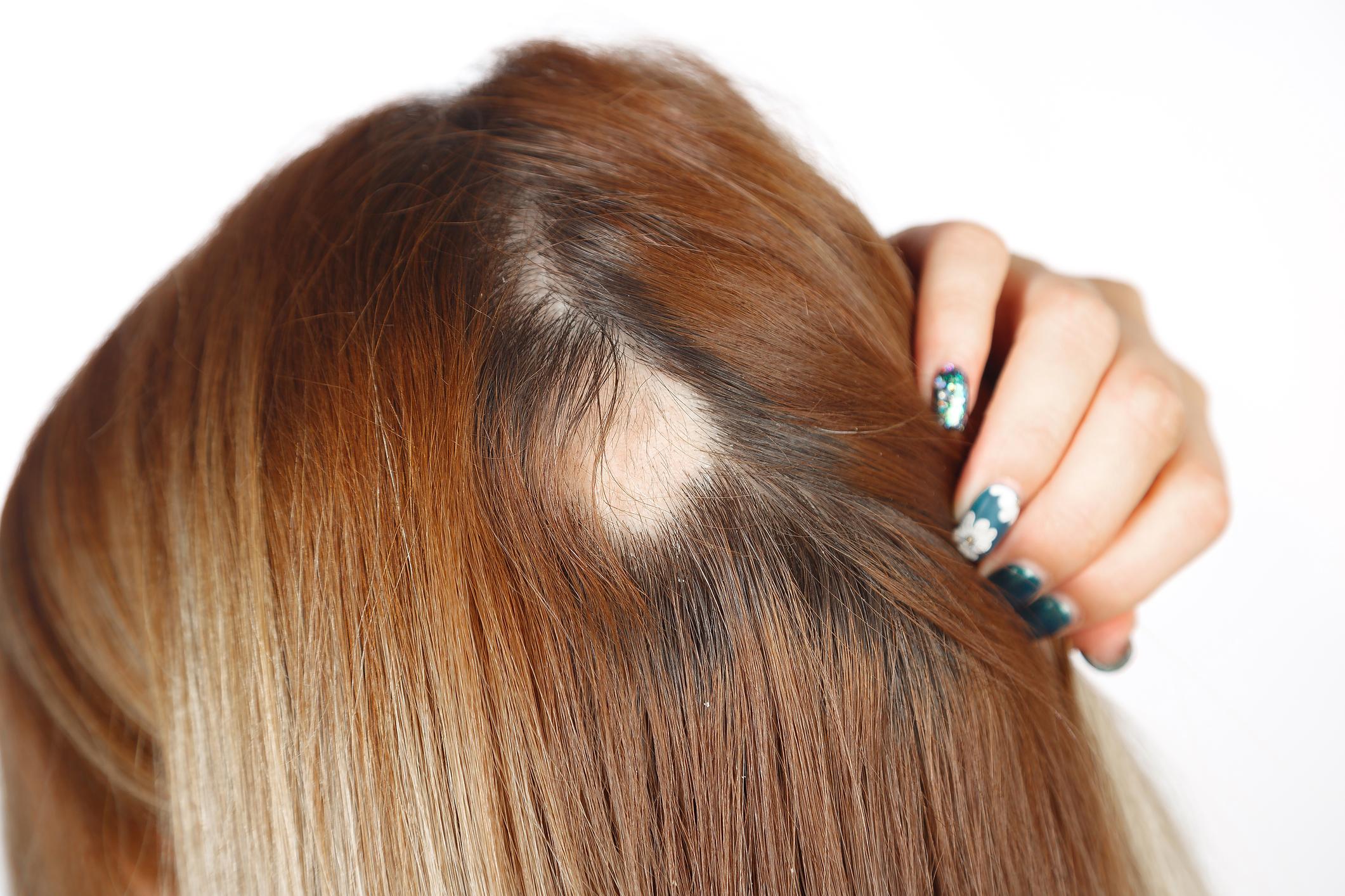 Alopecia